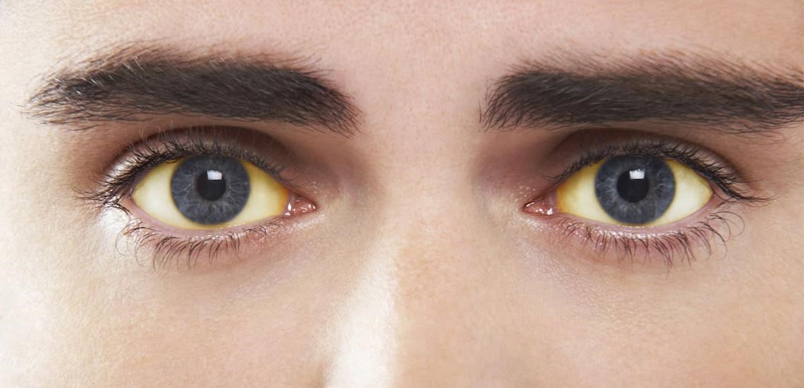 زرد شدن پوست و چشم: