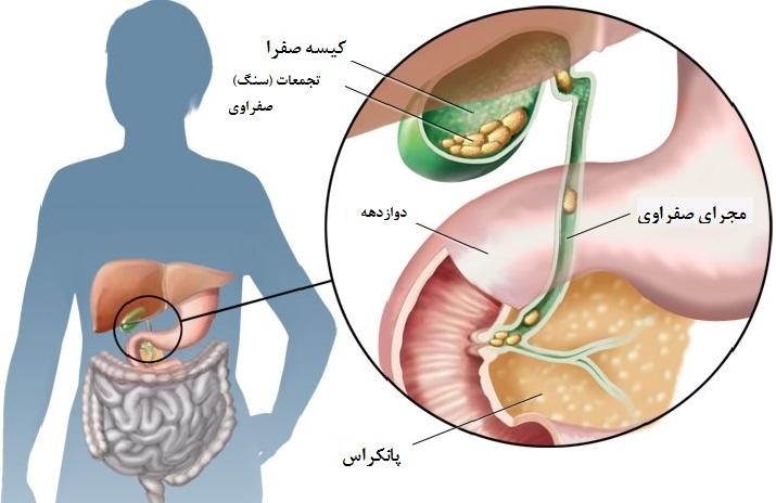 رژیم غذایی برای پولیپ کیسه صفرا