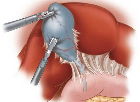 آیا با مهم ترین ویژگی های ظاهری پولیپ های کیسه صفرا آشنایی دارید؟